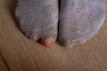 Torn gray socks on a man's feet, fingers sticking out of holes in the fabric