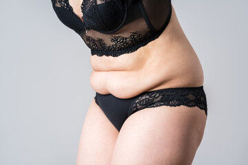 Tummy tuck, flabby skin on a fat belly, plastic surgery concept