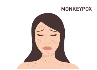 Woman suffering from new virus Monkeypox infection on her face vector illustration. Smallpox virus concept
