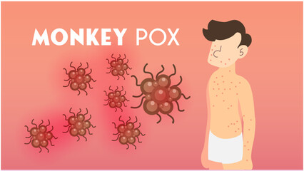 Illustration of monkeypox virus, Vector of a person with monkeypox, Concept of monkeypox, illustration of hives on the skin of monkeypox