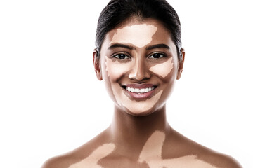 Beautiful South Asian woman with vitiligo skin disorder against white background