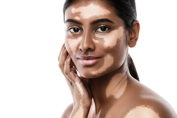 Beautiful South Asian woman with vitiligo skin disorder against white background