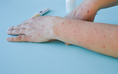 Monkey pox virus, a new world problem of modern humanity. Close-up of the hands of a sick person...