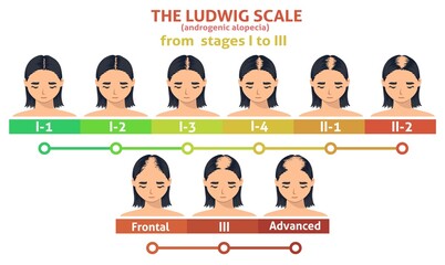 Ludwig scale of androgenic alopecia step poster - obrazy, fototapety, plakaty