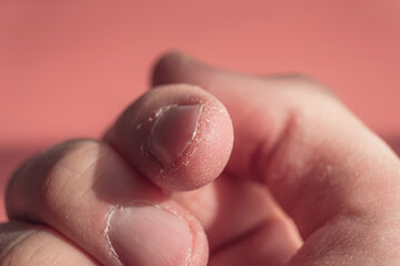 dry hand skin. dermatitis close-up, skin peeling.