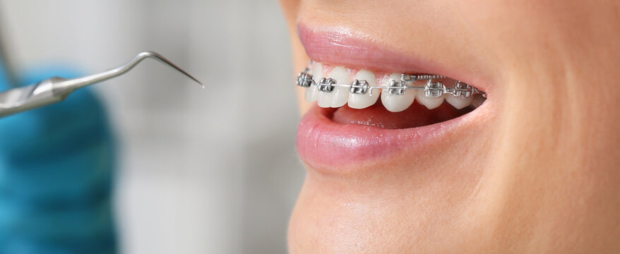 Woman With Dental Braces Visiting Dentist In Clinic, Closeup