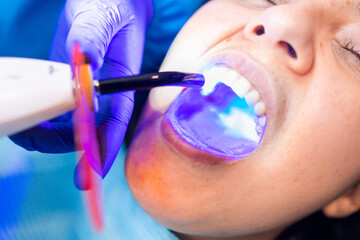 Tooth restoration with filling and polymerization lamp. Dental curing light setting composite...