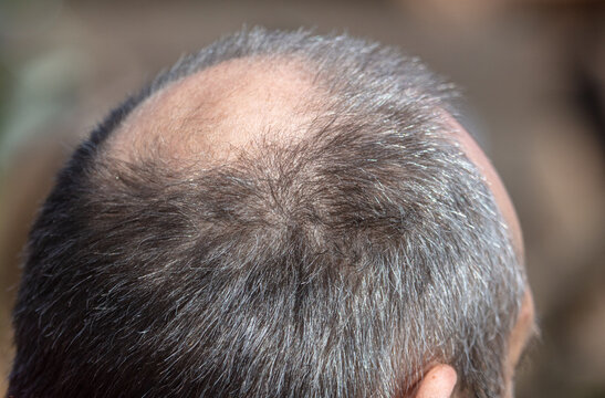 Bald patch on the head of a man.