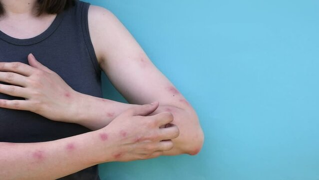 Woman scratches her hands with rash, red spots blisters. Monkeypox new disease dangerous over the world. Patient with Monkey Pox. Close up rash, human with Health problem. Copy space