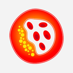 Blood Clot Human artery clot