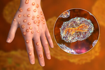 Hand of a patient with monkeypox infection, 3D illustration - obrazy, fototapety, plakaty