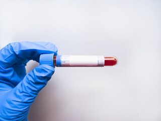 The hand of a doctor holding a blood sample tube