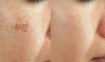 Cropped Image before and after spot melasma pigmentation facial treatment on middle age asian woman face. skincare and health problem concept. - obrazy, fototapety, plakaty