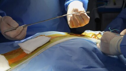 The neurosurgeon performs ventriculo-peritoneal shunting. Shunt medical conductor. Surgery for ventriculo-peritoneal shunting with a shunt guide.