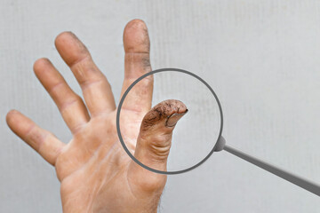 dry skin of the hand and fingers of a man with cracks and vitamin deficiency. Hands of a male...