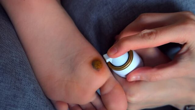 Treatment of a laser-removed wart on the foot with a foam analgesic anti-inflammatory medicine. Sore, wound after operation. Wound of removed wart. Applying foam remedy on the affected area.