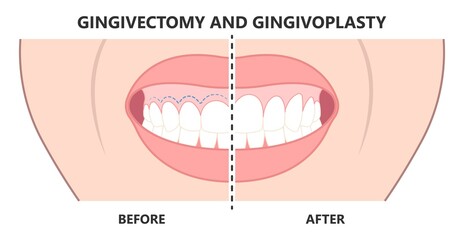 Gingivectomy gum graft smile small teeth deep cleaning prep flap dental attached gingiva alveolar bone laser tooth Care lift tissue treat clean plaque bacteria Tartar calculus