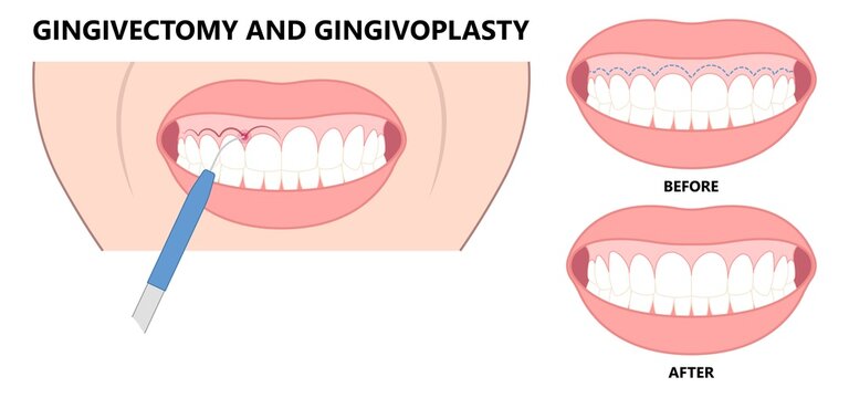 Gingivectomy Gum Graft Smile Small Teeth Deep Cleaning Prep Flap Dental Attached Gingiva Alveolar Bone Laser Tooth Care Lift Tissue Treat Clean Plaque Bacteria Tartar Calculus