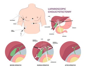 gallbladder cystic bile duct cancer pain drain polyps fine needle test and chole diagnose  obstructive Acute tract stones