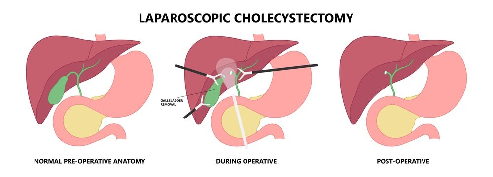 gallbladder cystic bile duct cancer pain drain polyps fine needle test and chole diagnose  obstructive Acute tract stones