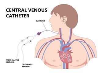 Fototapeta premium Vascular access for kidney graft shunt lumen with PICC line tube chest care artery vein arm Blood vessel flow neck liver and CRRT intravenous injection Total Nutrition