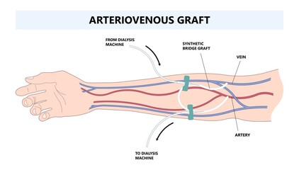 Vascular access for kidney graft shunt lumen with PICC line tube chest care artery vein arm Blood vessel flow neck liver and CRRT intravenous injection Total Nutrition - obrazy, fototapety, plakaty