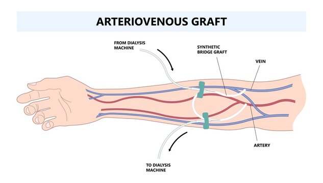 Vascular access for kidney graft shunt lumen with PICC line tube chest care artery vein arm Blood vessel flow neck liver and CRRT intravenous injection Total Nutrition