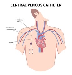 PICC Line insert neck tube vein arm blood draws heart IV needle cancer therapy Total peripheral internal double lumen chest port fluid injection large artery superior vena cava care drug implantation - obrazy, fototapety, plakaty