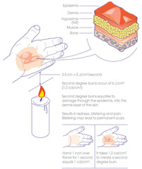 Second Degree Burns Infographic Explained on Hand with cross-section of Skin Layers - 506962686