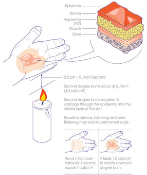 Second Degree Burns Infographic Explained on Hand with cross-section of Skin Layers