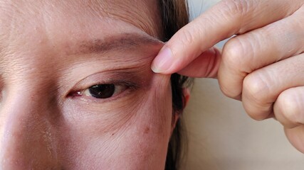 close up of a person holding the flabbiness skin on the eyelid, problem wrinkles and cellulite under the face of the woman, concept health care.