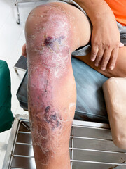 Skin disorderand pepper appearance scleroderma, autoimmune disease hand foot skin disorder pepper appearance from vitiligo,scleroderma raynaud, medical concept  dermatology disease.sective focus.