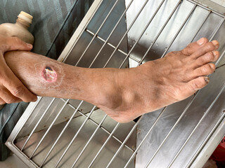 Skin disorderand pepper appearance scleroderma, autoimmune disease hand foot skin disorder pepper...