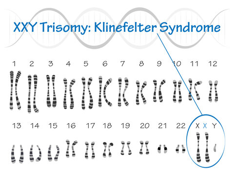 Klinefelter Syndrome Karyotype