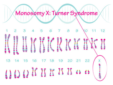 Monosomy X: Turner Syndrome Karyotype