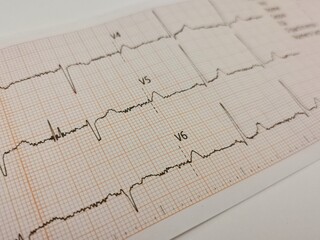 ecg graph on ecg
