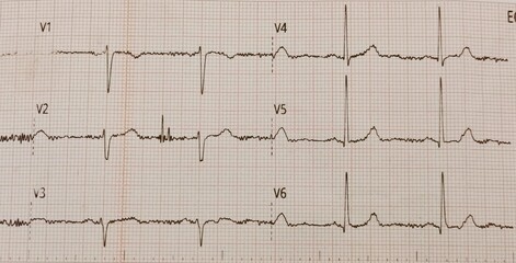 ecg graph on ecg. 