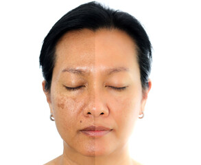 Image before and after spot melasma pigmentation facial treatment on asian woman face. skincare and...
