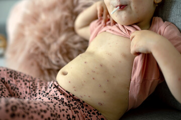 Little toddler girl with chicken pox in bed, playing at home, quarantine isolation