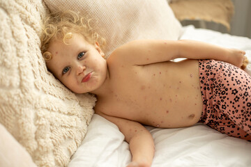 Little toddler girl with chicken pox in bed, playing at home, quarantine isolation