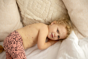 Little toddler girl with chicken pox in bed, playing at home, quarantine isolation