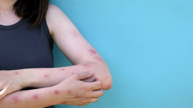 Monkeypox new disease dangerous over the world. Patient with Monkey Pox. Painful rash, red spots blisters on the hand. Close up rash, human hands with Health problem. Banner, copy space.