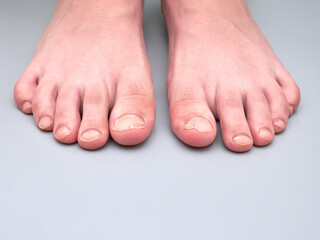Toenails of a 9 year old boy with a nail disease, very weak or brittle nails, isolated on gray background - obrazy, fototapety, plakaty