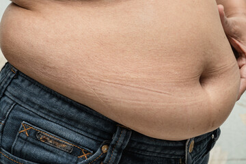 Overweight Asian woman show fat belly to burn and loss weight and limit calories.