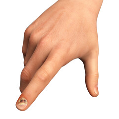 Human hand with onychomycosis