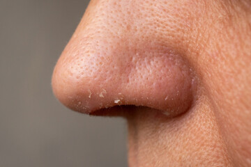 Close up to femenine nouse with dead skin cells