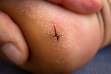 Cracked heel with deep wound