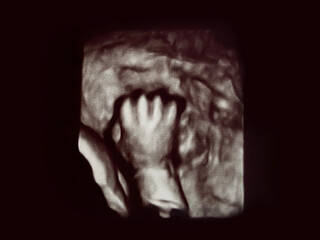 fetal baby hand ultrasound picture