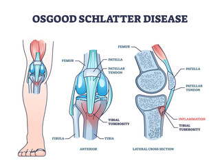 Osgood schlatter disease condition with leg and knee joint pain outline diagram. Labeled educational medical scheme with patella tendon inflammation and tibial tuberosity anatomy vector illustration. - obrazy, fototapety, plakaty