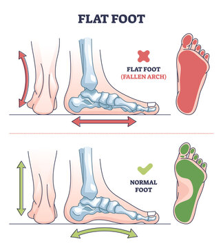Flat foot pathology with fallen and normal arch comparison outline diagram. Labeled educational scheme with ankle and feet bone stretching position vector illustration. Medical human skeleton disease.